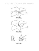 VERTEBRAL JOINT IMPLANTS AND DELIVERY TOOLS diagram and image