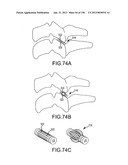 VERTEBRAL JOINT IMPLANTS AND DELIVERY TOOLS diagram and image