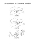 VERTEBRAL JOINT IMPLANTS AND DELIVERY TOOLS diagram and image