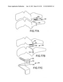 VERTEBRAL JOINT IMPLANTS AND DELIVERY TOOLS diagram and image