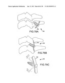 VERTEBRAL JOINT IMPLANTS AND DELIVERY TOOLS diagram and image