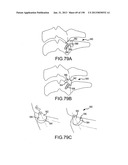 VERTEBRAL JOINT IMPLANTS AND DELIVERY TOOLS diagram and image