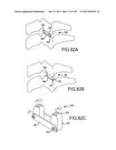 VERTEBRAL JOINT IMPLANTS AND DELIVERY TOOLS diagram and image