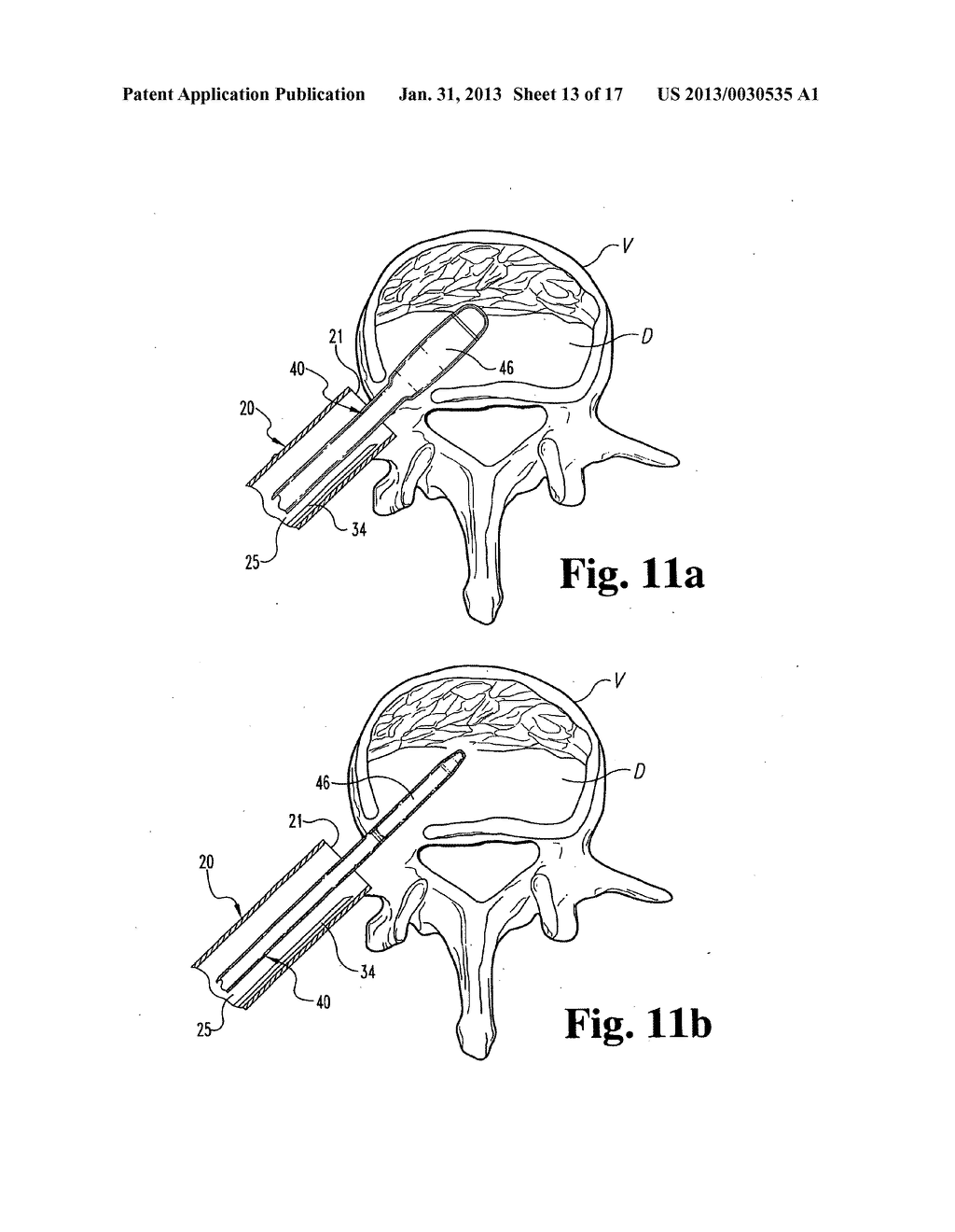 METHODS AND INSTRUMENTS FOR ENDOSCOPIC INTERBODY SURGICAL TECHNIQUES - diagram, schematic, and image 14