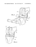 Method And Apparatus For Positioning A Multiple Piece Prosthesis diagram and image