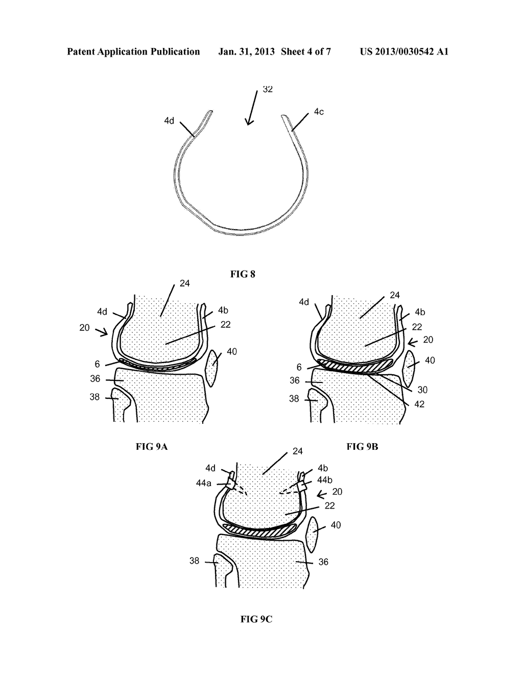 RESILIENT KNEE IMPLANT AND METHODS - diagram, schematic, and image 05