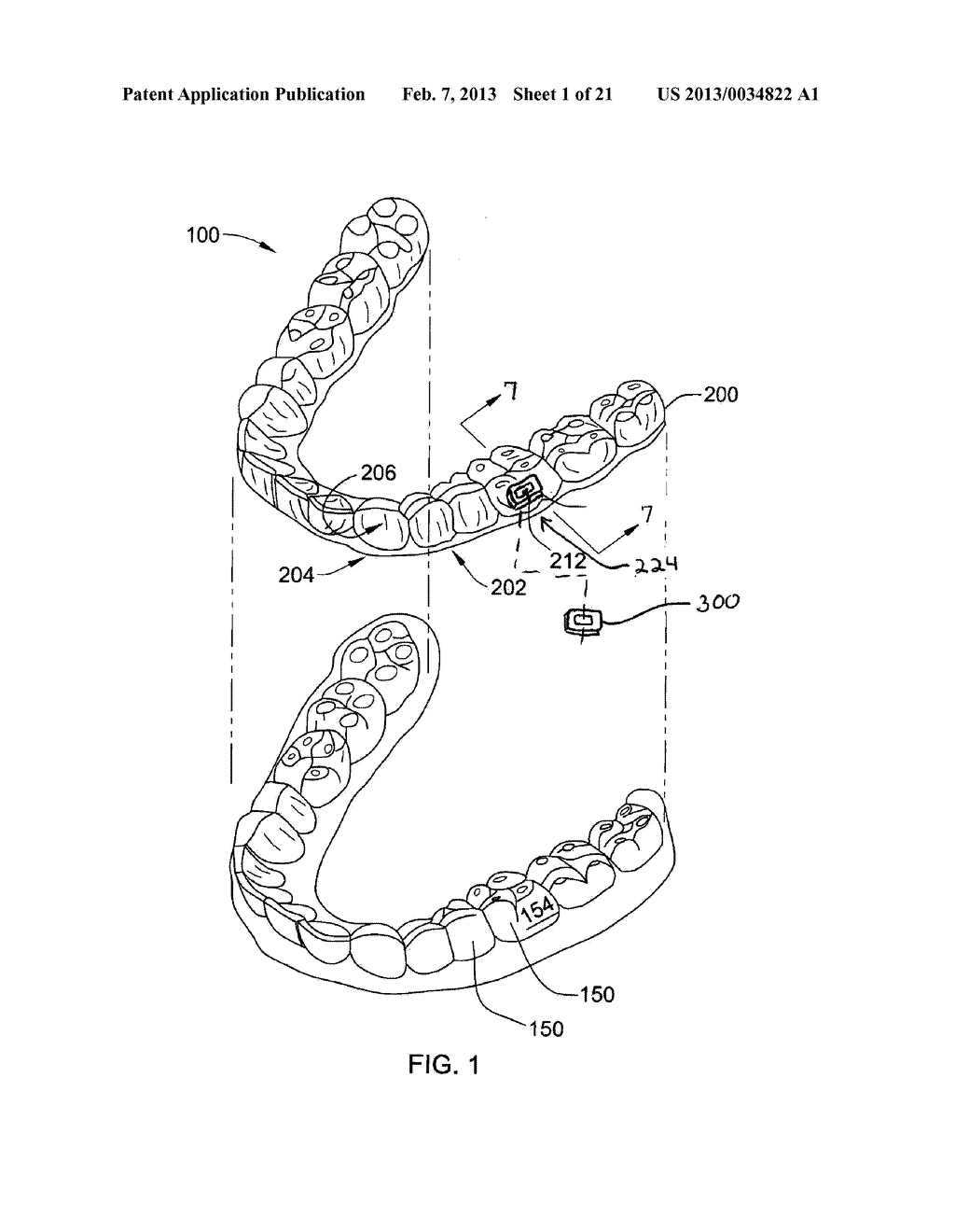 ORTHODONTIC ATTACHMENT DEVICE SYSTEMS AND METHODS - diagram, schematic, and image 02