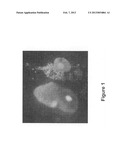 EARLY MARKER OF PROTEINURIA IN PATIENTS TREATED WITH AN ANTI-VEGF     TREATMENT diagram and image