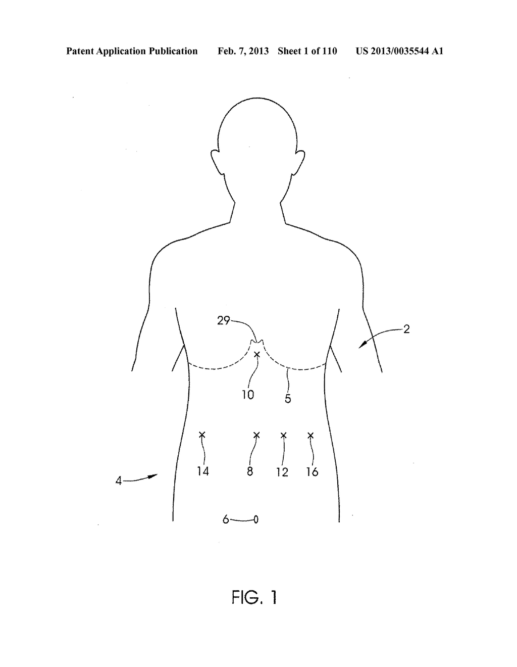 ADJUSTABLE IMPLANT AND METHOD OF USE - diagram, schematic, and image 02