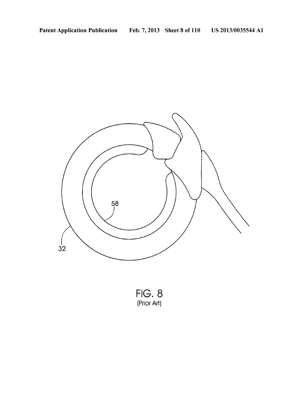 ADJUSTABLE IMPLANT AND METHOD OF USE - diagram, schematic, and image 09