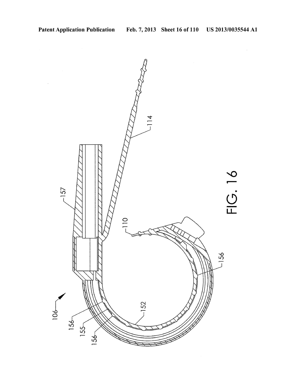 ADJUSTABLE IMPLANT AND METHOD OF USE - diagram, schematic, and image 17