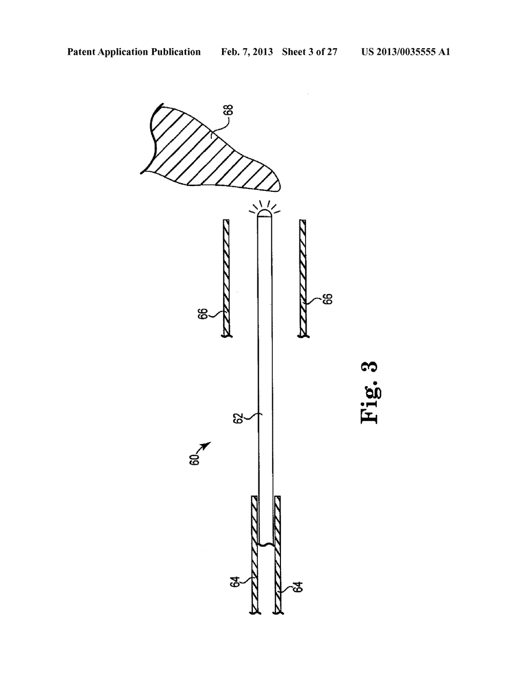 SYSTEMS, IMPLANTS, TOOLS, AND METHODS FOR TREATMENT OF PELVIC CONDITIONS - diagram, schematic, and image 04