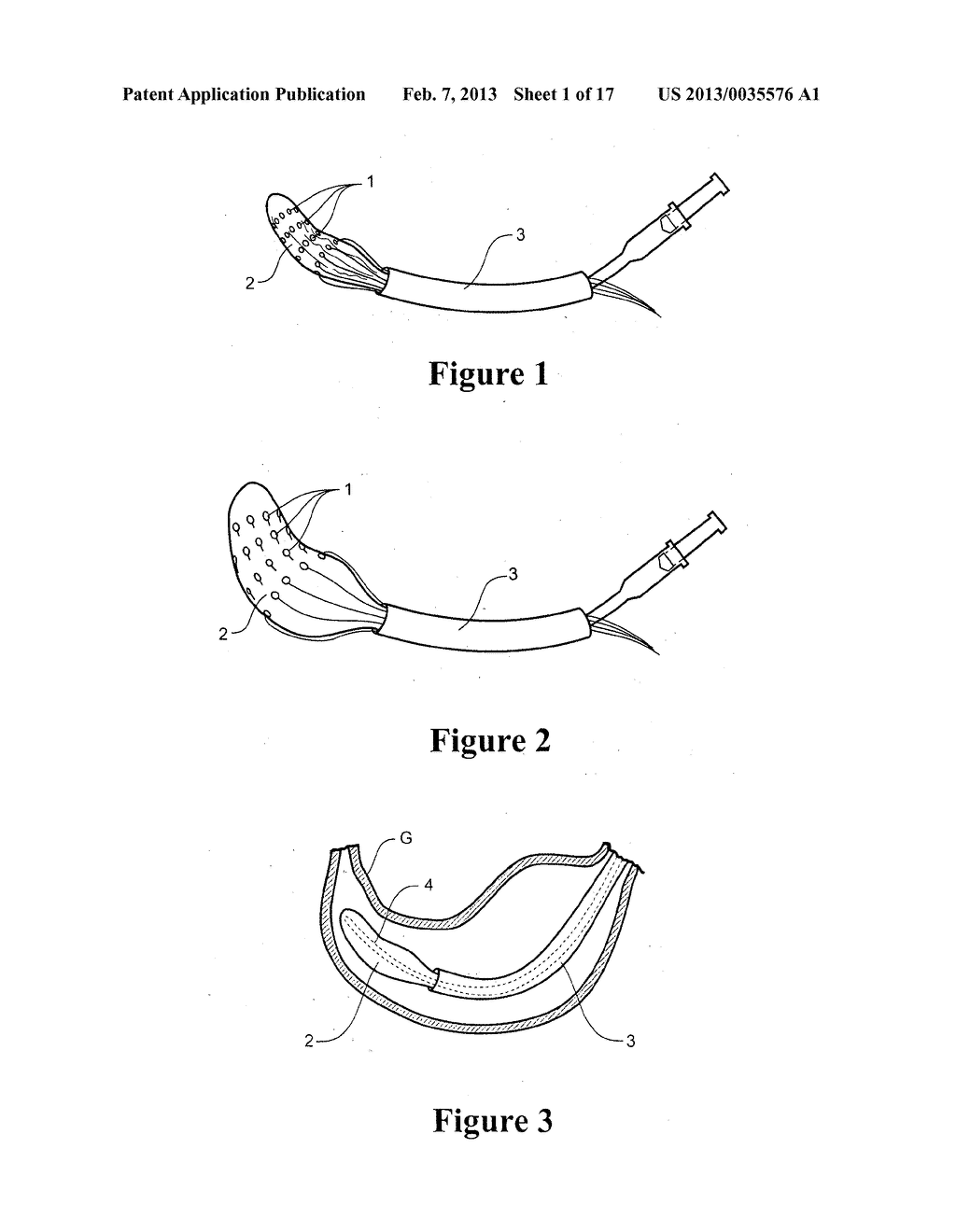 SYSTEM AND METHOD FOR MAPPING GASTRO-INTESTINAL ELECTRICAL ACTIVITY - diagram, schematic, and image 02