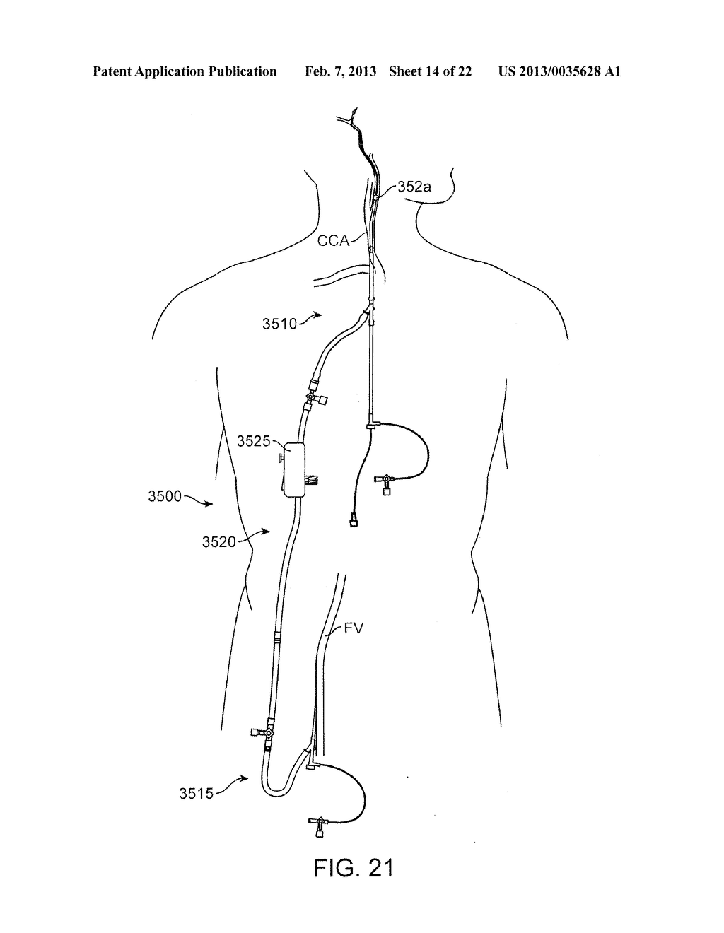METHODS AND SYSTEMS FOR TREATMENT OF ACUTE ISCHEMIC STROKE - diagram, schematic, and image 15