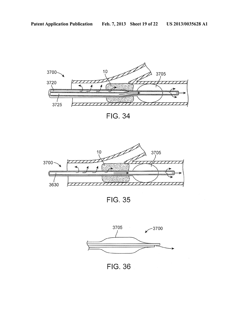 METHODS AND SYSTEMS FOR TREATMENT OF ACUTE ISCHEMIC STROKE - diagram, schematic, and image 20