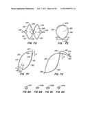 DEVICES AND METHODS FOR VESSEL OCCLUSION diagram and image