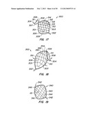 DEVICES AND METHODS FOR VESSEL OCCLUSION diagram and image