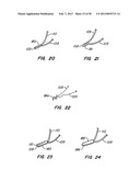 DEVICES AND METHODS FOR VESSEL OCCLUSION diagram and image