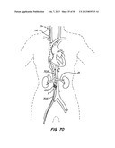 DEVICES AND METHODS FOR VESSEL OCCLUSION diagram and image