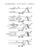 DEVICES AND METHODS FOR VESSEL OCCLUSION diagram and image