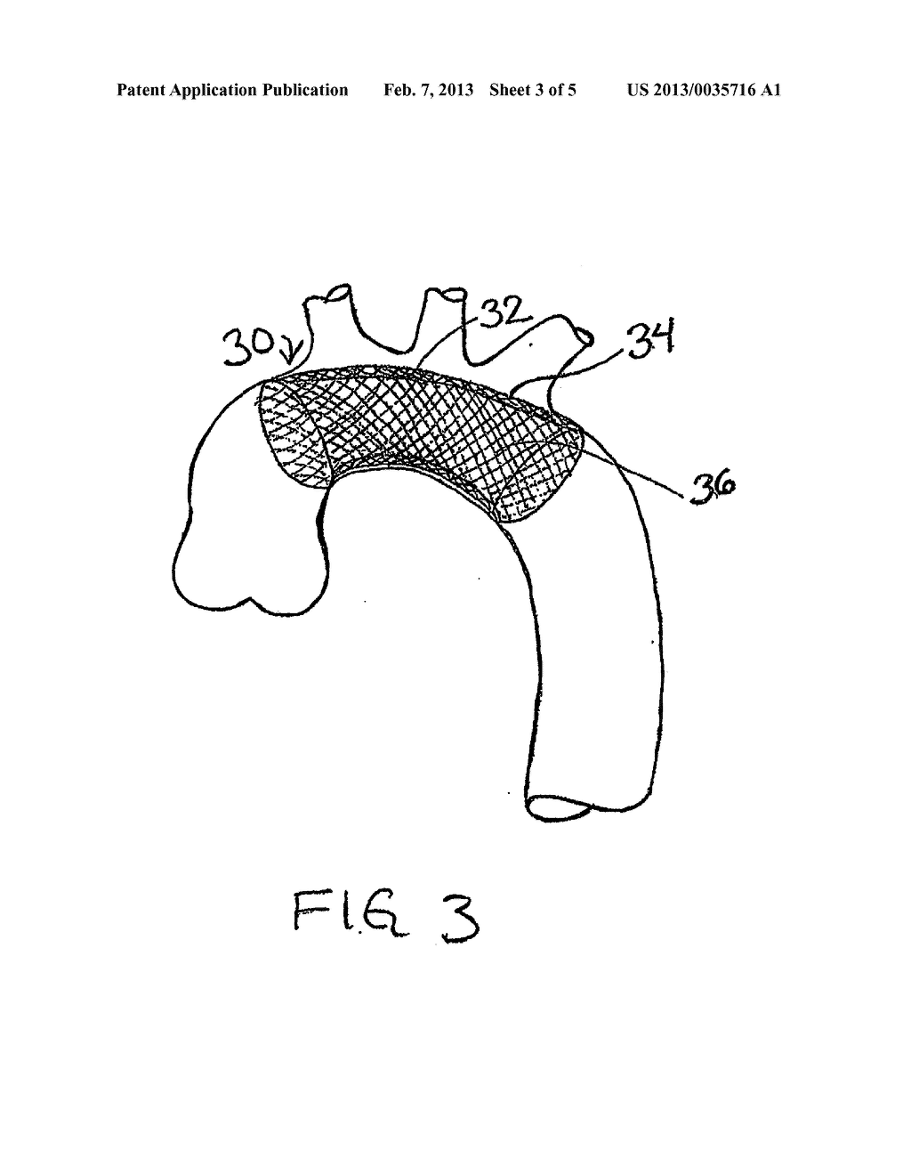 EMBOLIC PROTECTION DEVICE - diagram, schematic, and image 04