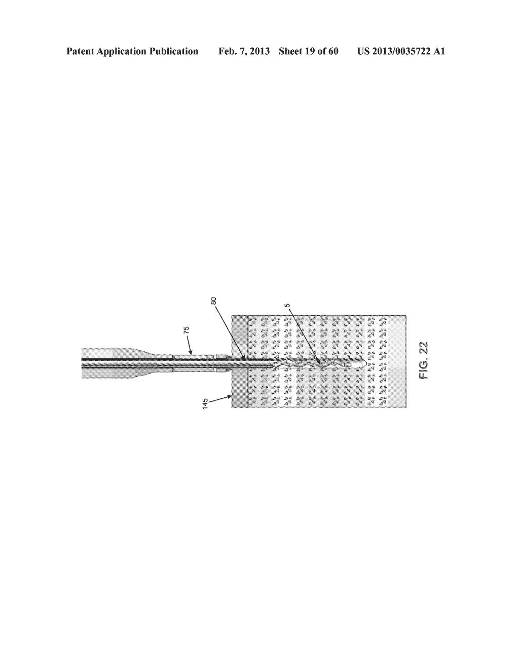 METHOD AND APPARATUS FOR SECURING AN OBJECT TO BONE, INCLUDING THE     PROVISION AND USE OF A NOVEL SUTURE ASSEMBLY FOR SECURING AN OBJECT TO     BONE - diagram, schematic, and image 20