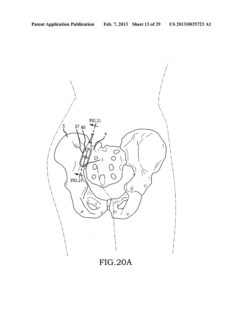 SACROILIAC JOINT FIXATION FUSION SYSTEM - diagram, schematic, and image 14