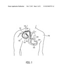 INTERCONNECTION OF CONDUCTOR TO FEEDTHROUGH diagram and image