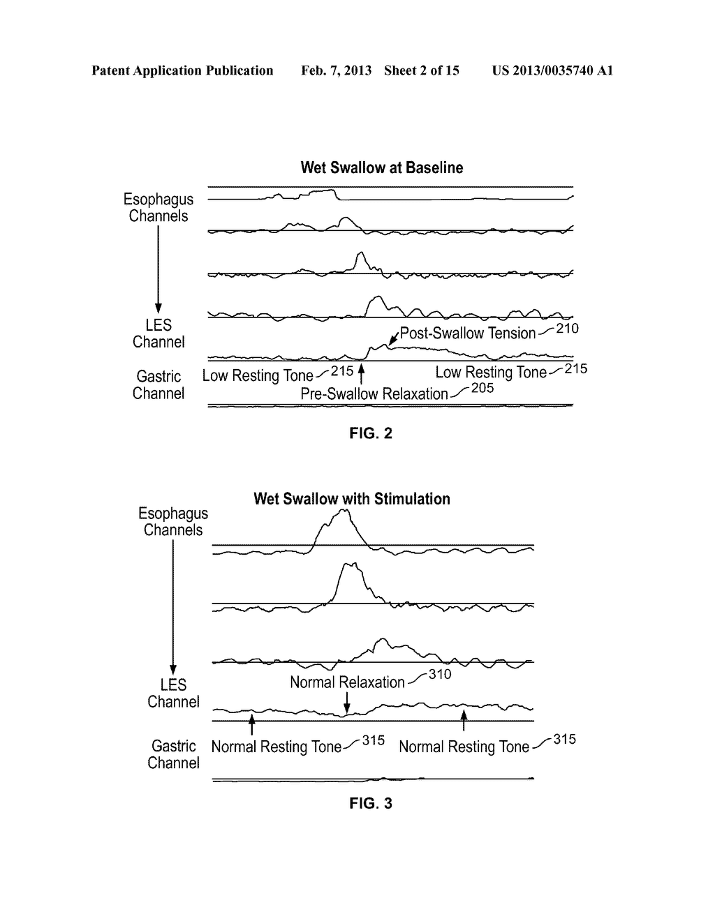 Device and Implantation System for Electrical Stimulation of Biological     Systems - diagram, schematic, and image 03