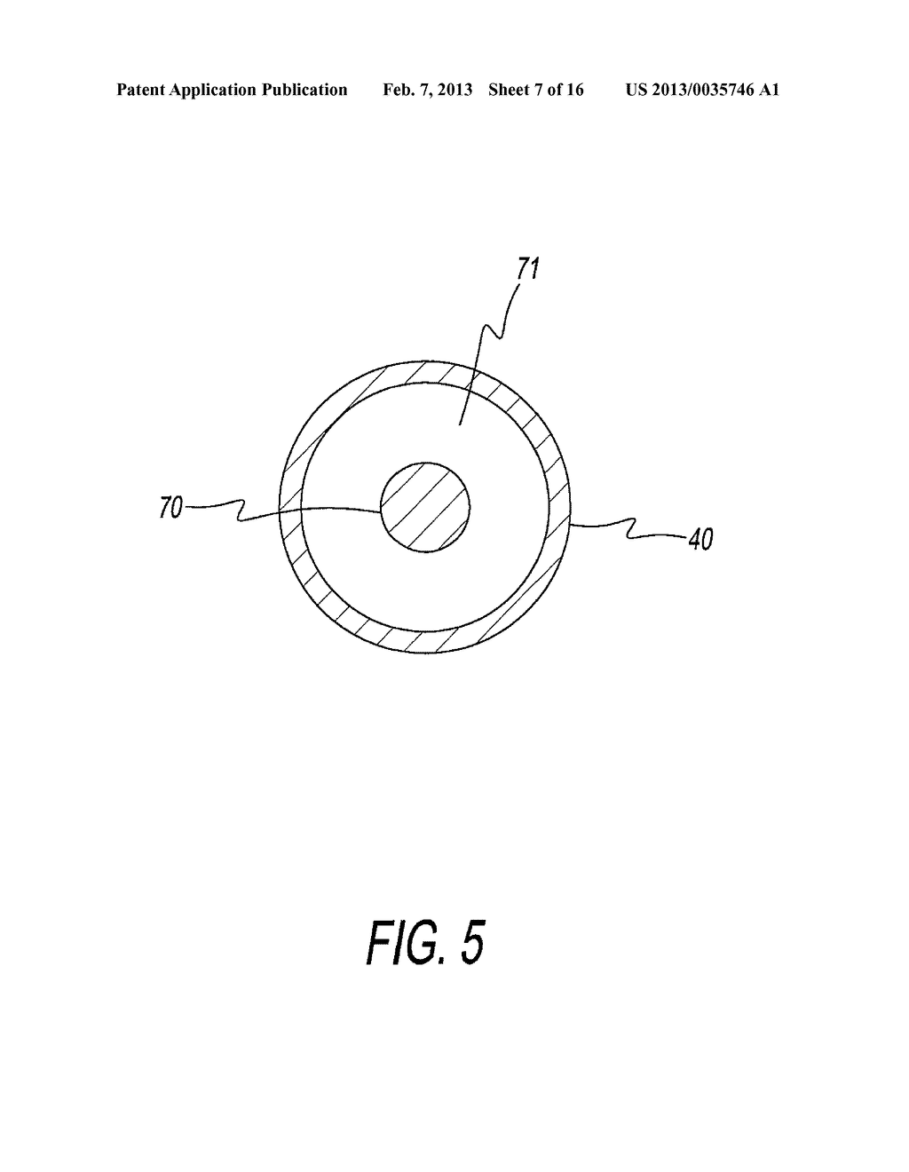 APPARATUS AND METHOD FOR TREATING RHINITIS - diagram, schematic, and image 08