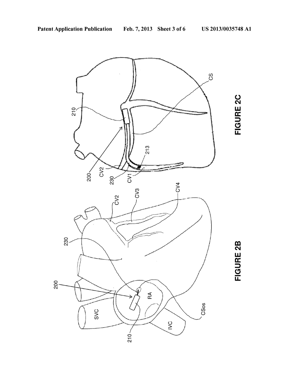 IMPLANT SYSTEM INCLUDING GUIDING ACCESSORY AND METHODS OF USE - diagram, schematic, and image 04