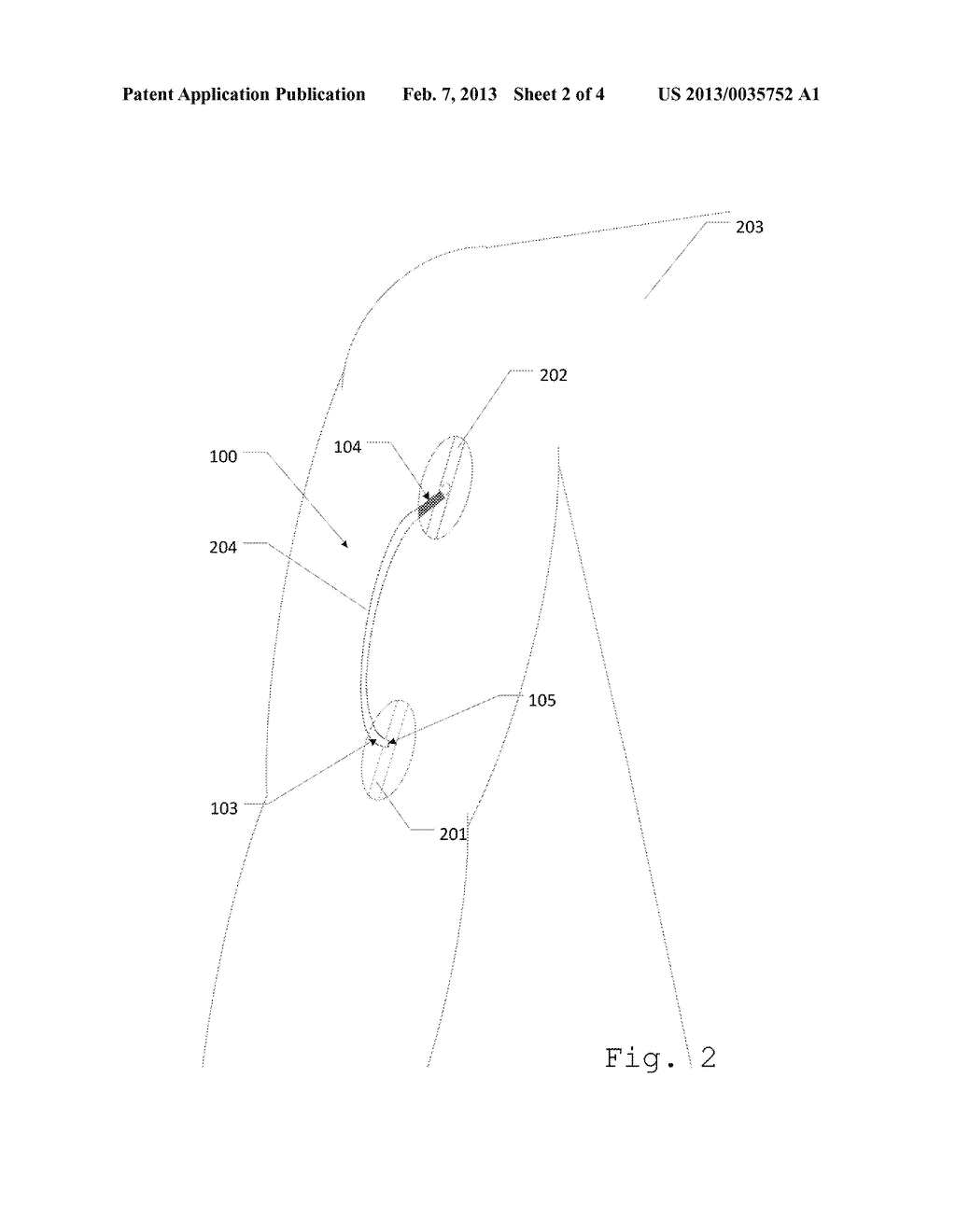 Dialysis Arterial-Venous Graft - diagram, schematic, and image 03