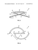 Apparatus for Treating a Heart Valve, In Particular a Mitral Valve diagram and image