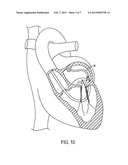 Apparatus for Treating a Heart Valve, In Particular a Mitral Valve diagram and image