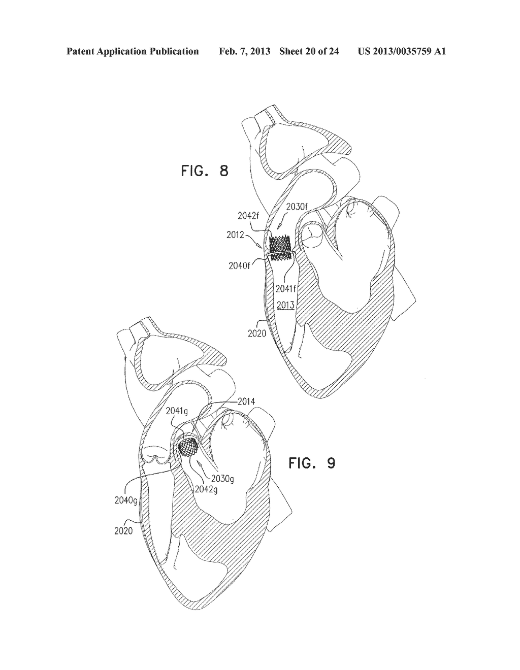 TECHNIQUES FOR PERCUTANEOUS MITRAL VALVE REPLACEMENT AND SEALING - diagram, schematic, and image 21