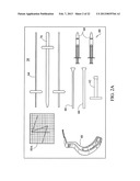 SUBCHONDRAL TREATMENT TO PREVENT THE PROGRESSION OF OSTEOARTHRITIS OF THE     JOINT diagram and image