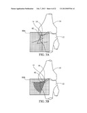 SUBCHONDRAL TREATMENT TO PREVENT THE PROGRESSION OF OSTEOARTHRITIS OF THE     JOINT diagram and image