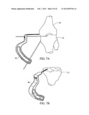 SUBCHONDRAL TREATMENT TO PREVENT THE PROGRESSION OF OSTEOARTHRITIS OF THE     JOINT diagram and image