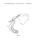 SUBCHONDRAL TREATMENT TO PREVENT THE PROGRESSION OF OSTEOARTHRITIS OF THE     JOINT diagram and image