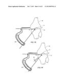 SUBCHONDRAL TREATMENT TO PREVENT THE PROGRESSION OF OSTEOARTHRITIS OF THE     JOINT diagram and image