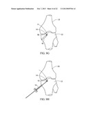 SUBCHONDRAL TREATMENT TO PREVENT THE PROGRESSION OF OSTEOARTHRITIS OF THE     JOINT diagram and image