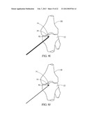 SUBCHONDRAL TREATMENT TO PREVENT THE PROGRESSION OF OSTEOARTHRITIS OF THE     JOINT diagram and image