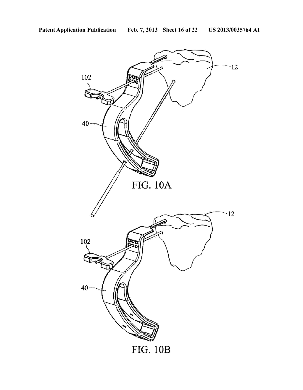 SUBCHONDRAL TREATMENT TO PREVENT THE PROGRESSION OF OSTEOARTHRITIS OF THE     JOINT - diagram, schematic, and image 17