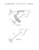 SUBCHONDRAL TREATMENT TO PREVENT THE PROGRESSION OF OSTEOARTHRITIS OF THE     JOINT diagram and image