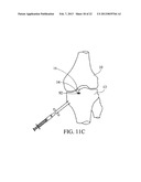 SUBCHONDRAL TREATMENT TO PREVENT THE PROGRESSION OF OSTEOARTHRITIS OF THE     JOINT diagram and image