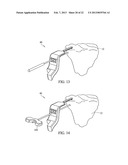 SUBCHONDRAL TREATMENT TO PREVENT THE PROGRESSION OF OSTEOARTHRITIS OF THE     JOINT diagram and image