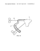 SUBCHONDRAL TREATMENT TO PREVENT THE PROGRESSION OF OSTEOARTHRITIS OF THE     JOINT diagram and image