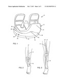 TOTAL KNEE ARTHROPLASTY WITH SYMMETRIC FEMORAL IMPLANT HAVING DOUBLE     Q-ANGLE TROCHLEAR GROOVE diagram and image