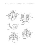 TOTAL KNEE ARTHROPLASTY WITH SYMMETRIC FEMORAL IMPLANT HAVING DOUBLE     Q-ANGLE TROCHLEAR GROOVE diagram and image