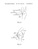 VARIABLE DENSITY TISSUE GRAFT COMPOSITION diagram and image